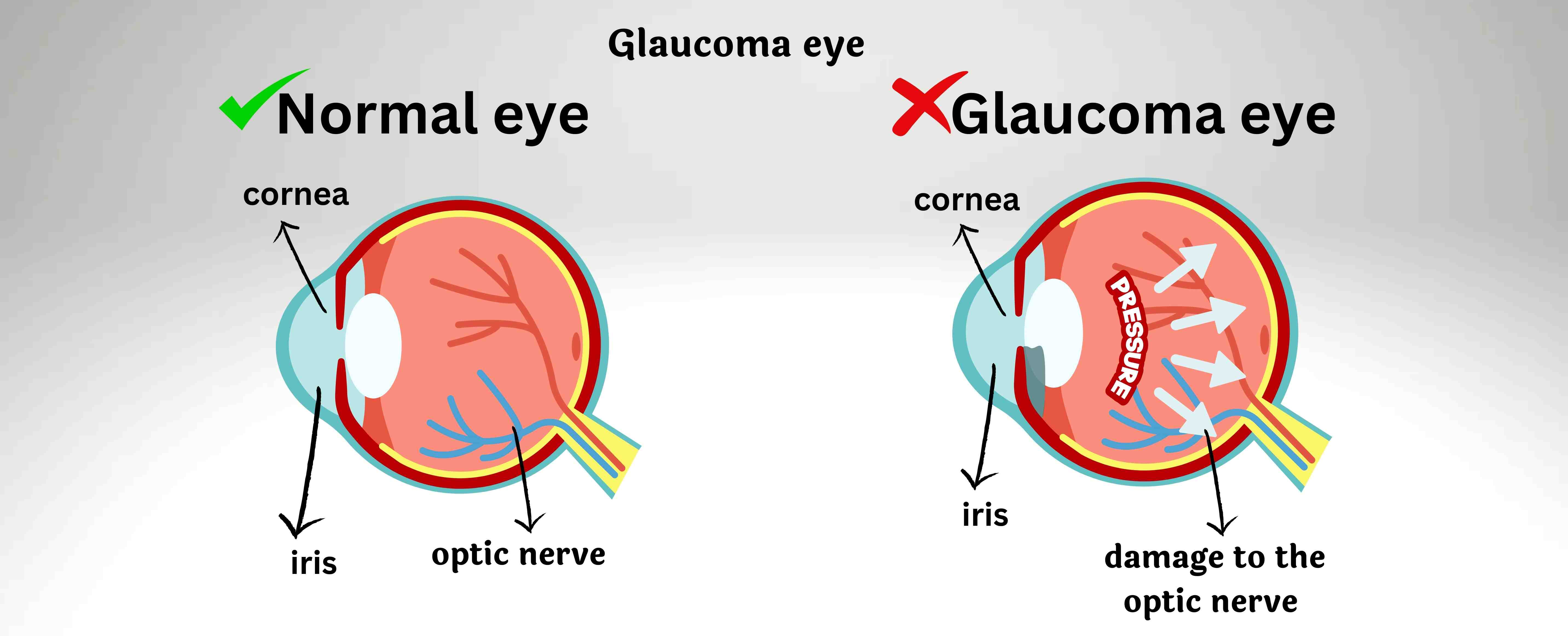 glaucoma